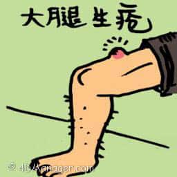 大腿生疮 sore on thigh