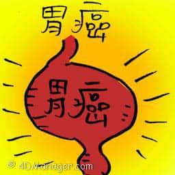 胃癌 gastric cancer